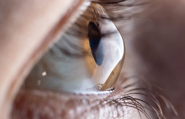 Macro Eye Photo. Keratoconus Eye Disease, Thinning Of The Cornea In The Form Of A Cone. The Cornea Plastic